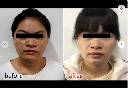 Household Rechargeable 4 Colors Soft Silicone Skincare Mask Skin Rejuvenation Anti-acne Anti-aging Face Mask